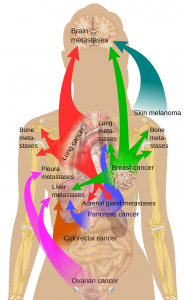 2000px-metastasis_sites_for_common_cancers-svg